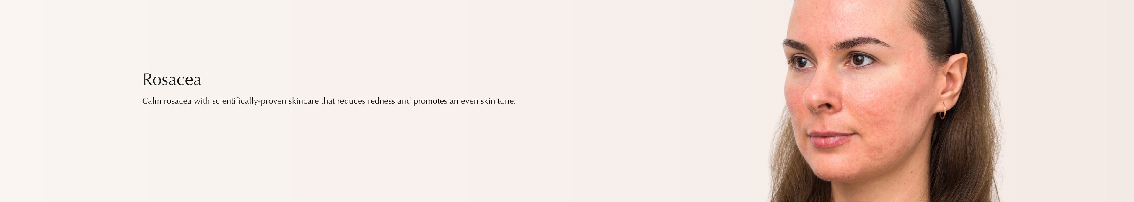 Rosacea