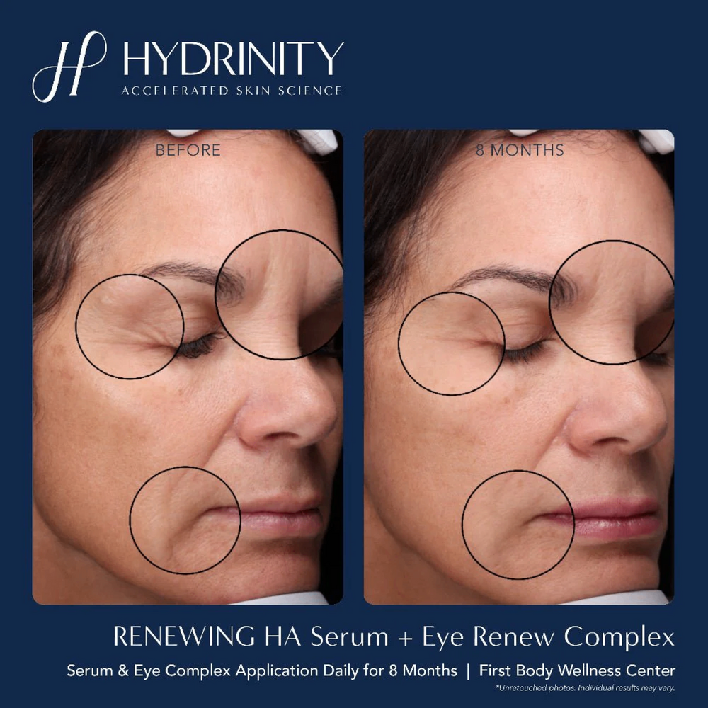 Hydrinity Reye Complex Hydrinity Eye Renew Complex | Dark Circle & Anti-Aging Eye Treatment