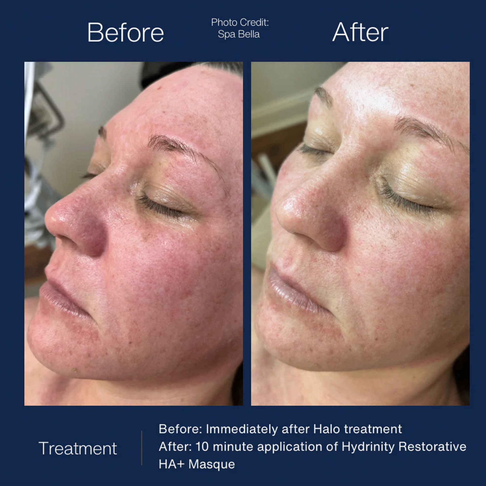 Hydrinity Restorative HA+ Masque (5 pack)