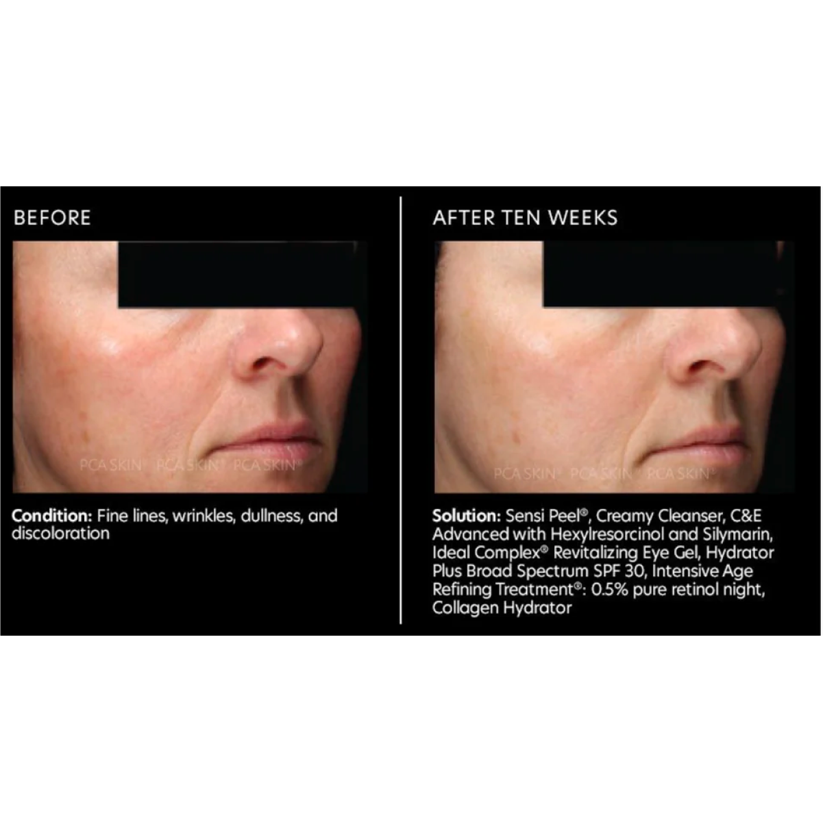 PCA Skin C&E Advanced with Hexylresorcinol