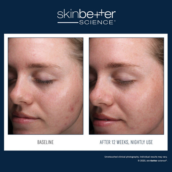 AlphaRet® Clearing Serum by skinbetter science, before and after | SkinCrew, Preferred Authorized skinbetter science US Retailer
