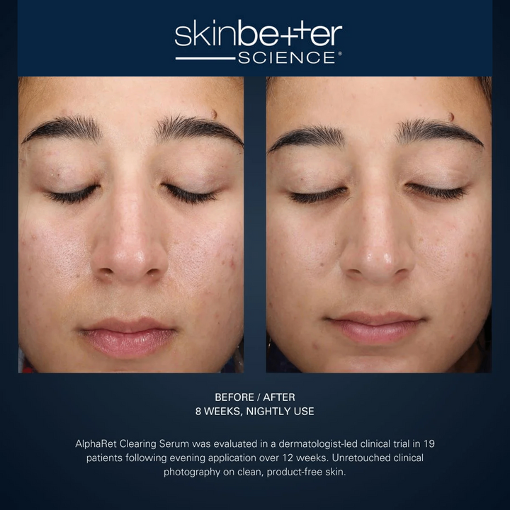 AlphaRet® Clearing Serum by skinbetter science, before and after | SkinCrew, Preferred Authorized skinbetter science US Retailer