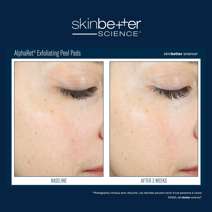 AlphaRet® Exfoliating Peel Pads by skinbetter science, before and after | SkinCrew, Preferred Authorized skinbetter science US Retailer