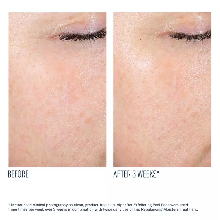 AlphaRet® Exfoliating Peel Pads by skinbetter science, before and after | SkinCrew, Preferred Authorized skinbetter science US Retailer