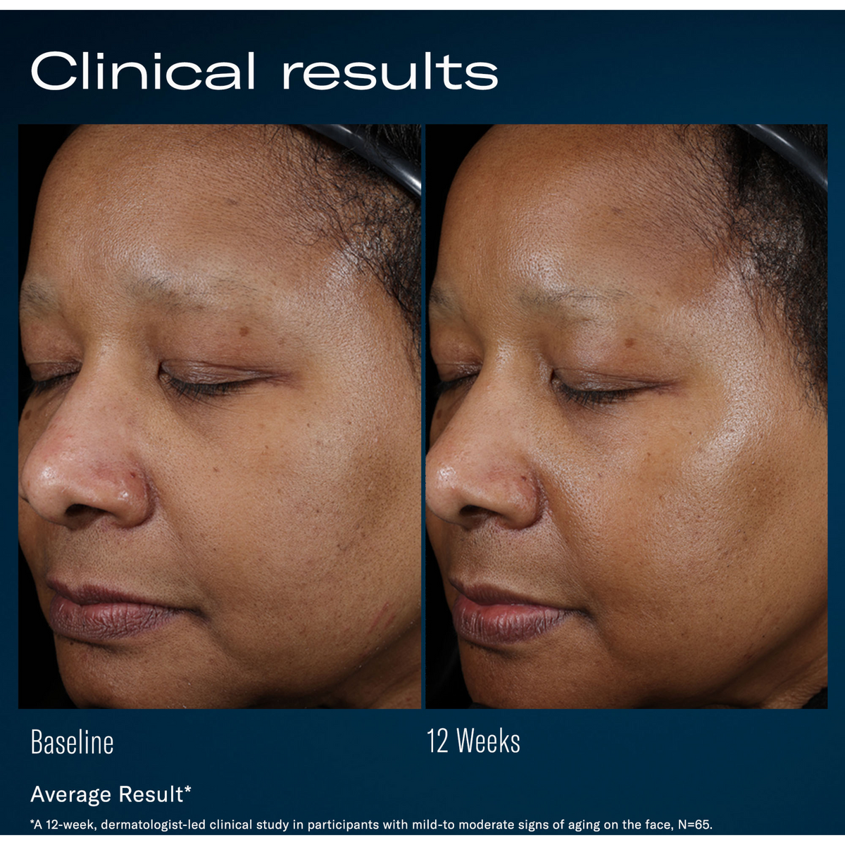 Ampra Volumizing Macro HA Serum by skinbetter science, clinical results | SkinCrew, Preferred Authorized skinbetter science US Retailer