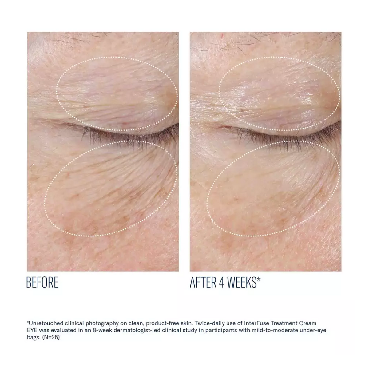 InterFuse® Treatment Cream EYE by skinbetter science, before and after | SkinCrew, Preferred Authorized skinbetter science US Retailer