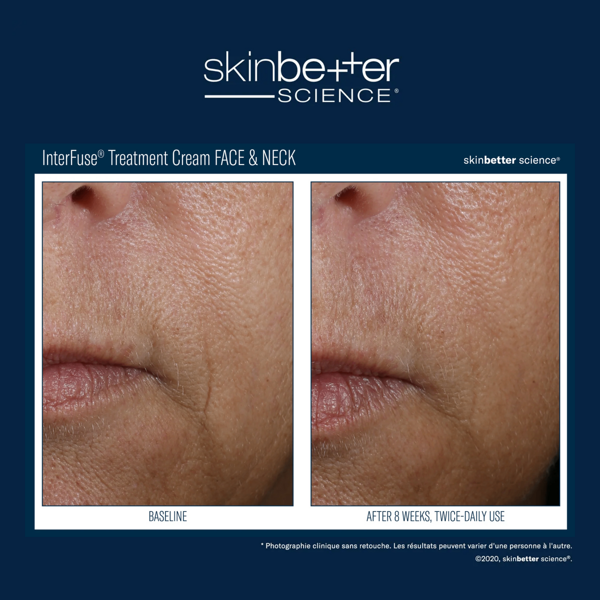 InterFuse® Treatment Cream FACE & NECK by skinbetter science, before and after | SkinCrew, Preferred Authorized skinbetter science US Retailer