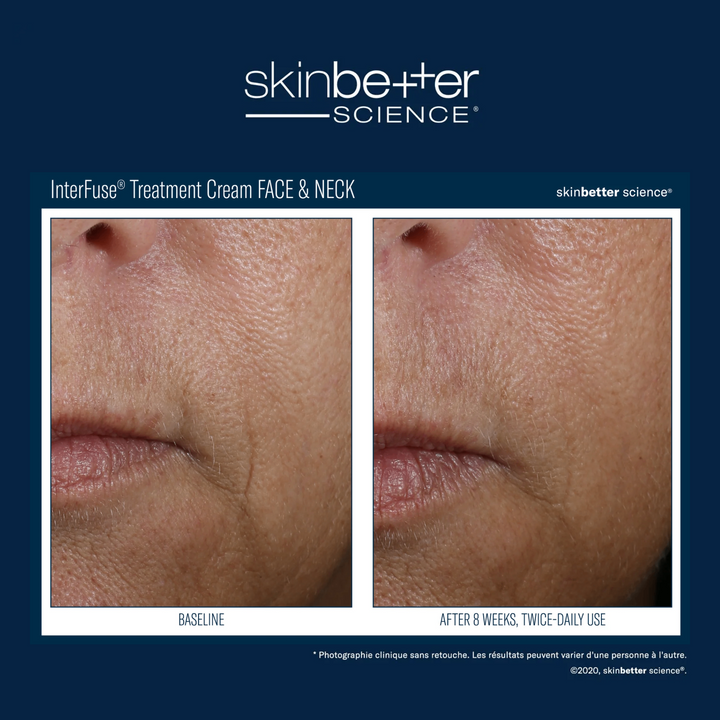 InterFuse® Treatment Cream FACE & NECK by skinbetter science, before and after | SkinCrew, Preferred Authorized skinbetter science US Retailer