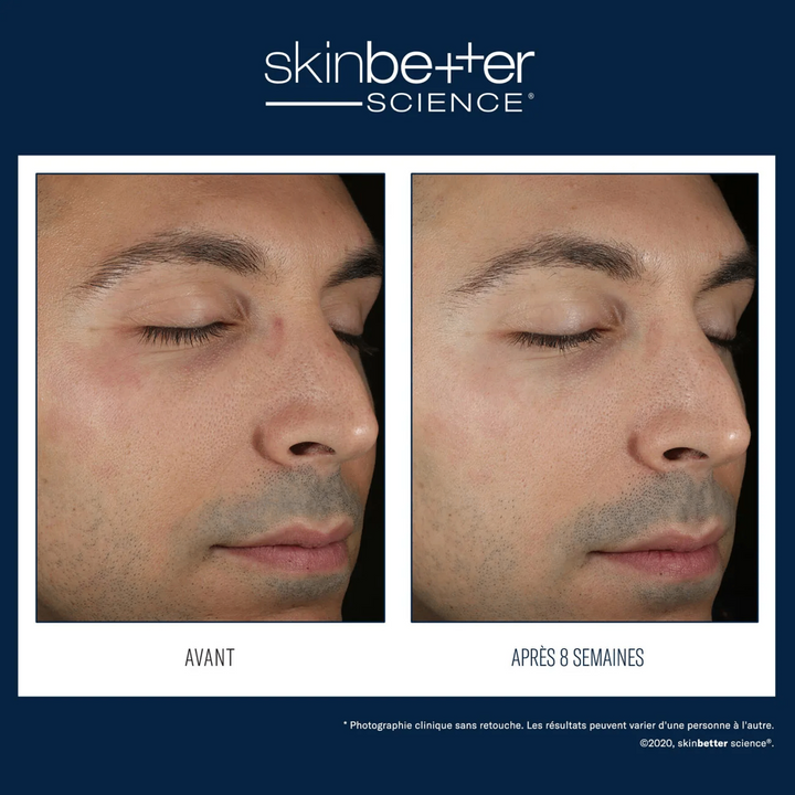 Solo Hydrating Defense MEN by skinbetter science, before and after | SkinCrew, Preferred Authorized skinbetter science US Retailer