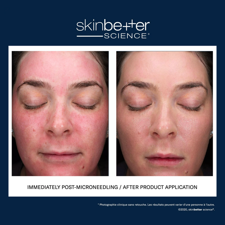 sunbetter® TONE SMART SPF 68 Sunscreen Compact by skinbetter science, before and after | SkinCrew, Preferred Authorized skinbetter science US Retailer
