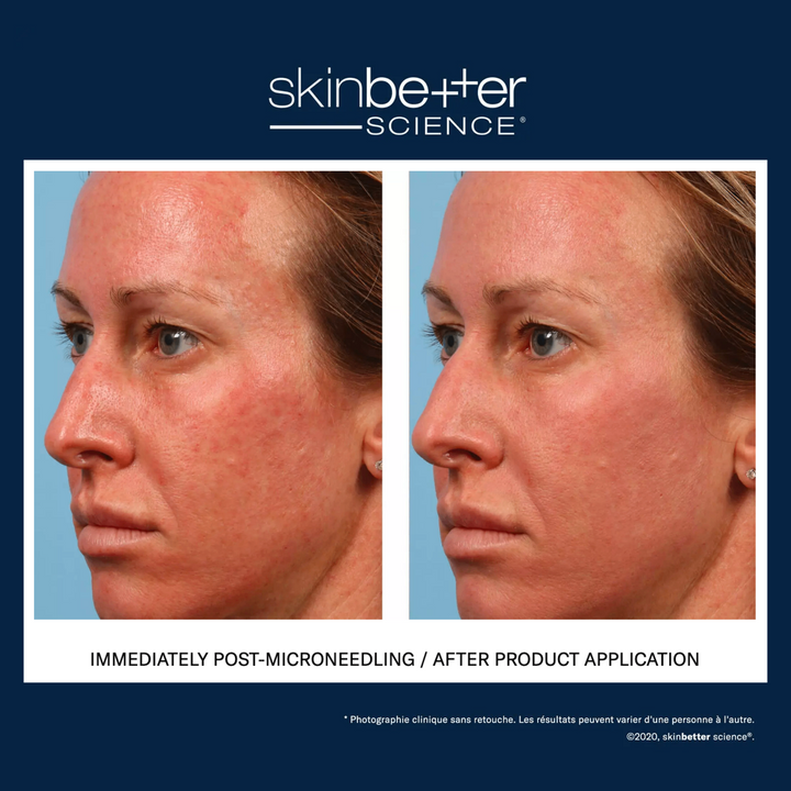 sunbetter® TONE SMART SPF 68 Sunscreen Compact by skinbetter science, before and after | SkinCrew, Preferred Authorized skinbetter science US Retailer