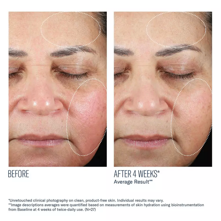 Trio Luxe Moisture Treatment by skinbetter science, before and after | SkinCrew, Preferred Authorized skinbetter science US Retailer